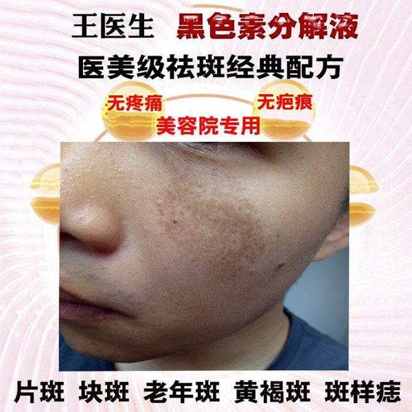 王医生祛斑祛痘